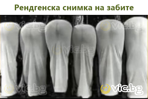 Zobu rentgena attēls