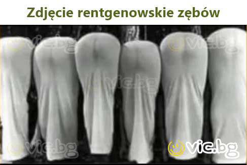 Zdjęcie rentgenowskie zębów