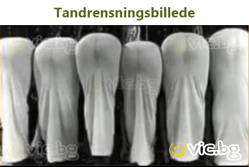 Tandrensningsbillede