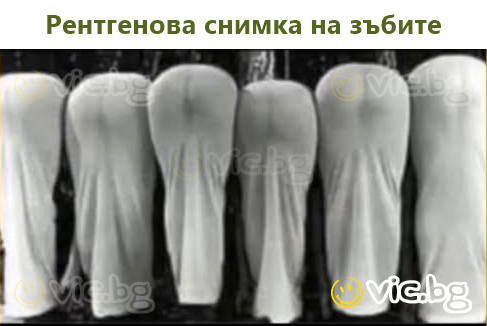 Рентгенова снимка на зъбите