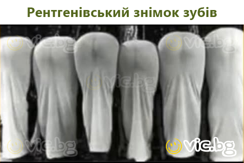 Рентгенівський знімок зубів